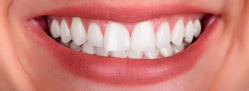 Depois do clareamento